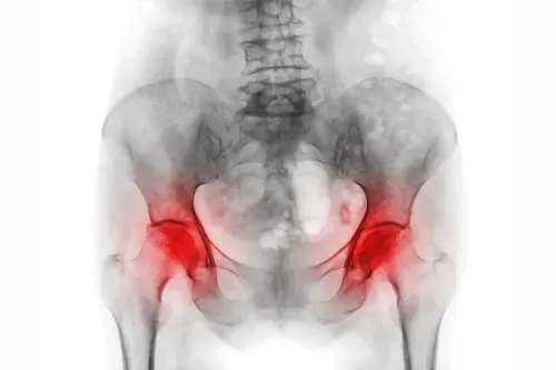 Avascular Necrosis and Its Impact on Bone Health